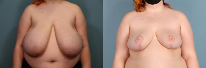Before & After Breast Reduction Case 382 Front View in Portland, OR