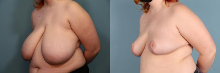 Before & After Breast Reduction Case 382 Left Oblique View in Portland, OR