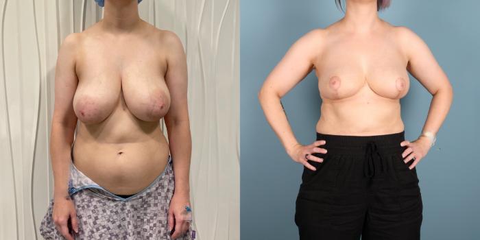 Before & After Breast Reduction Case 390 Front View in Portland, OR
