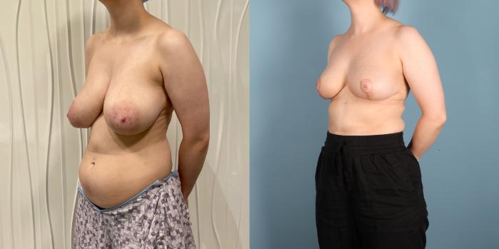 Before & After Breast Lift Case 390 Left Oblique View in Portland, OR
