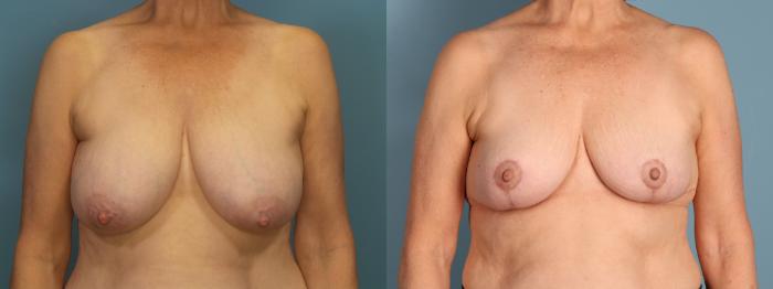 Before & After Breast Reduction Case 394 Front View in Portland, OR