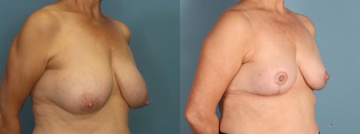 Before & After Breast Reduction Case 394 Right Oblique View in Portland, OR