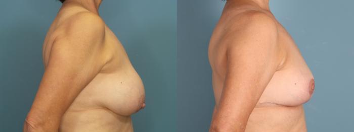 Before & After Breast Reduction Case 394 Right Side View in Portland, OR