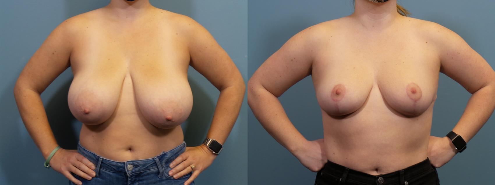 Before & After Breast Reduction Case 407 Front View in Portland, OR