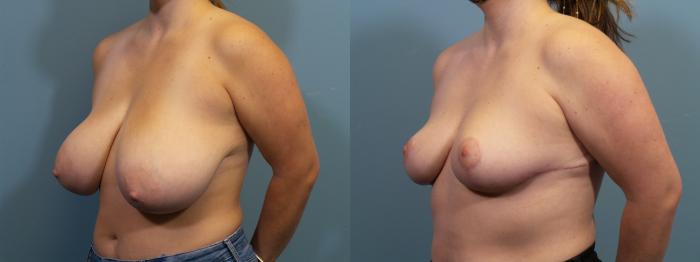 Before & After Breast Reduction Case 407 Left Oblique View in Portland, OR