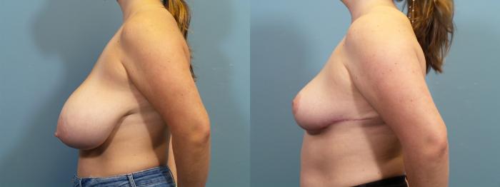 Before & After Breast Reduction Case 407 Left Side View in Portland, OR