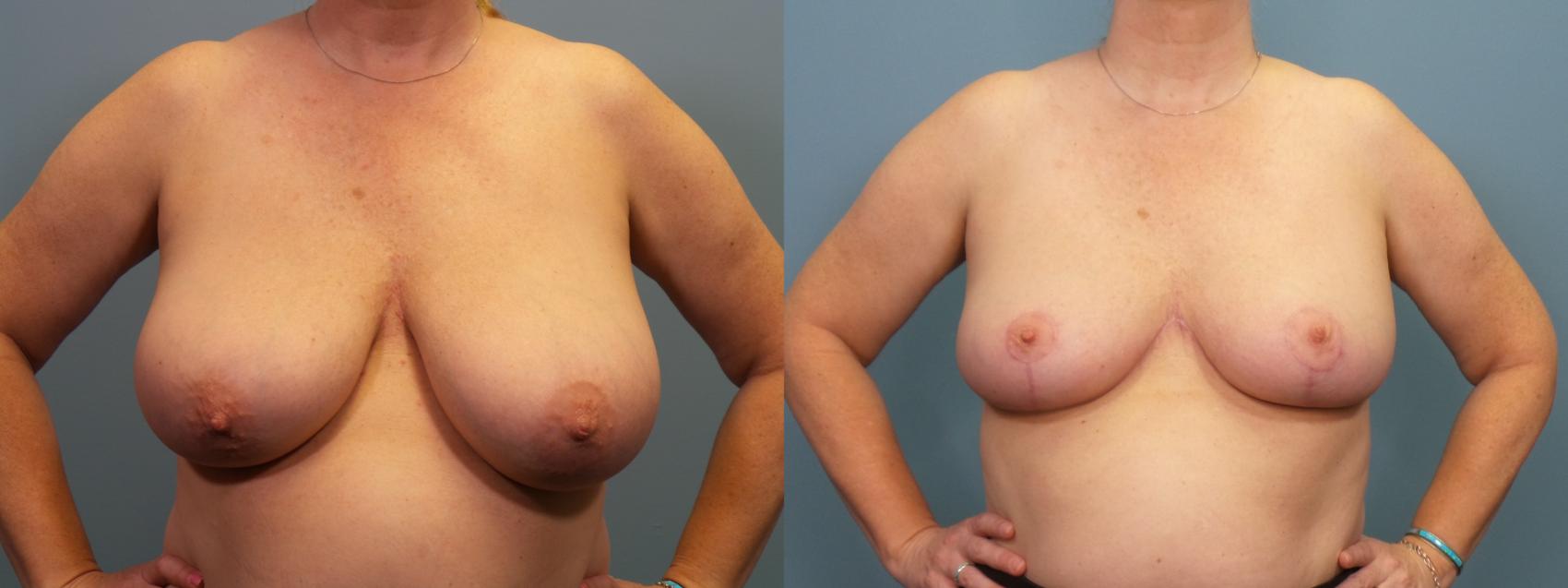 Before & After Breast Reduction Case 409 Front View in Portland, OR