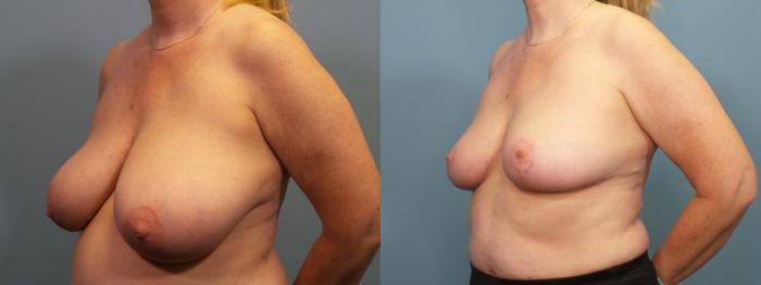 Before & After Breast Reduction Case 409 Left Oblique View in Portland, OR
