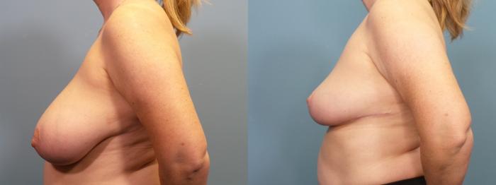 Before & After Breast Reduction Case 409 Left Side View in Portland, OR