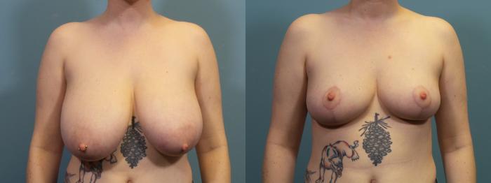 Before & After Breast Reduction Case 410 Front View in Portland, OR