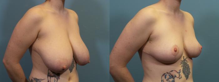Before & After Breast Reduction Case 410 Right Oblique View in Portland, OR