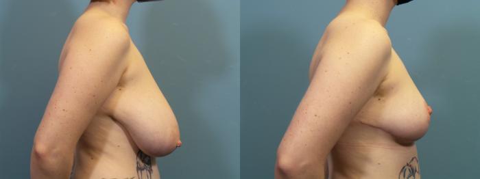 Before & After Breast Reduction Case 410 Right Side View in Portland, OR