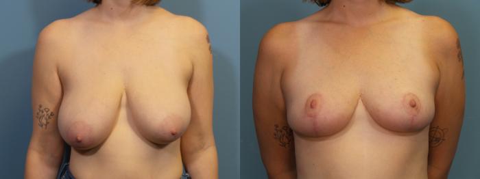 Before & After Breast Reduction Case 415 Front View in Portland, OR