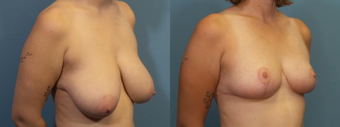 Before & After Breast Reduction Case 415 Right Oblique View in Portland, OR