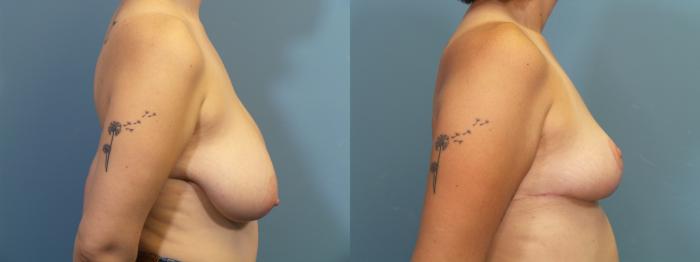 Before & After Breast Reduction Case 415 Right Side View in Portland, OR