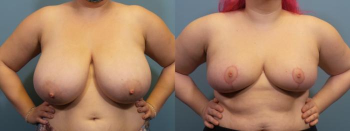 Before & After Breast Reduction Case 421 Front View in Portland, OR