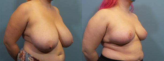 Before & After Breast Reduction Case 421 Right Oblique View in Portland, OR