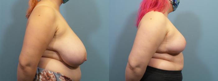 Before & After Breast Reduction Case 421 Right Side View in Portland, OR