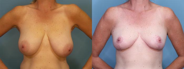 Before & After Breast Reduction Case 426 Front View in Portland, OR