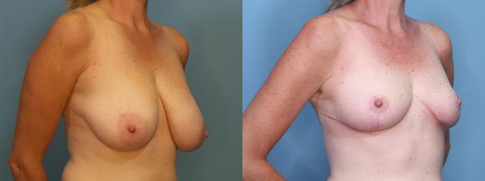 Before & After Breast Reduction Case 426 Right Oblique View in Portland, OR