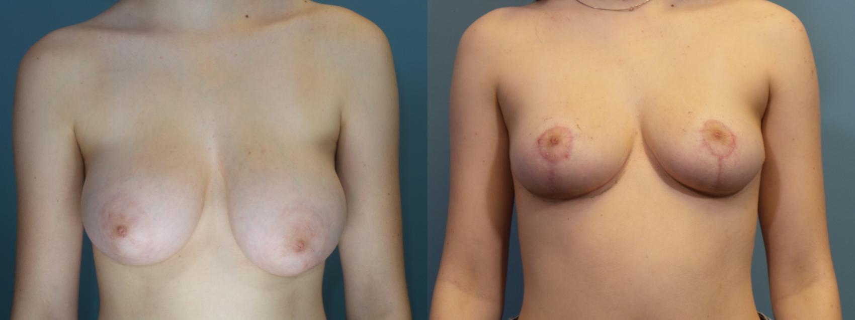 Before & After Breast Reduction Case 432 Front View in Portland, OR