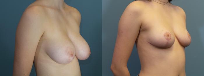 Before & After Breast Reduction Case 432 Right Oblique View in Portland, OR