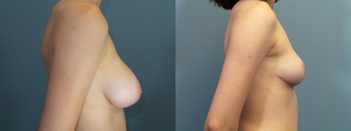 Before & After Breast Reduction Case 432 Right Side View in Portland, OR
