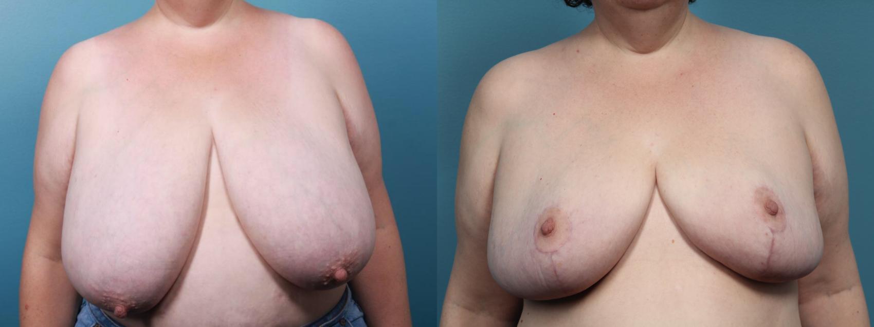 Before & After Breast Reduction Case 436 Front View in Portland, OR