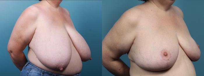 Before & After Breast Reduction Case 436 Right Oblique View in Portland, OR