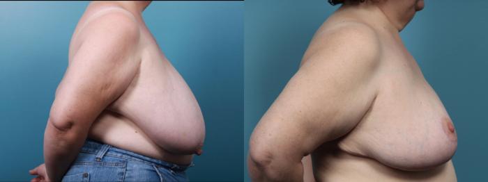 Before & After Breast Reduction Case 436 Right Side View in Portland, OR