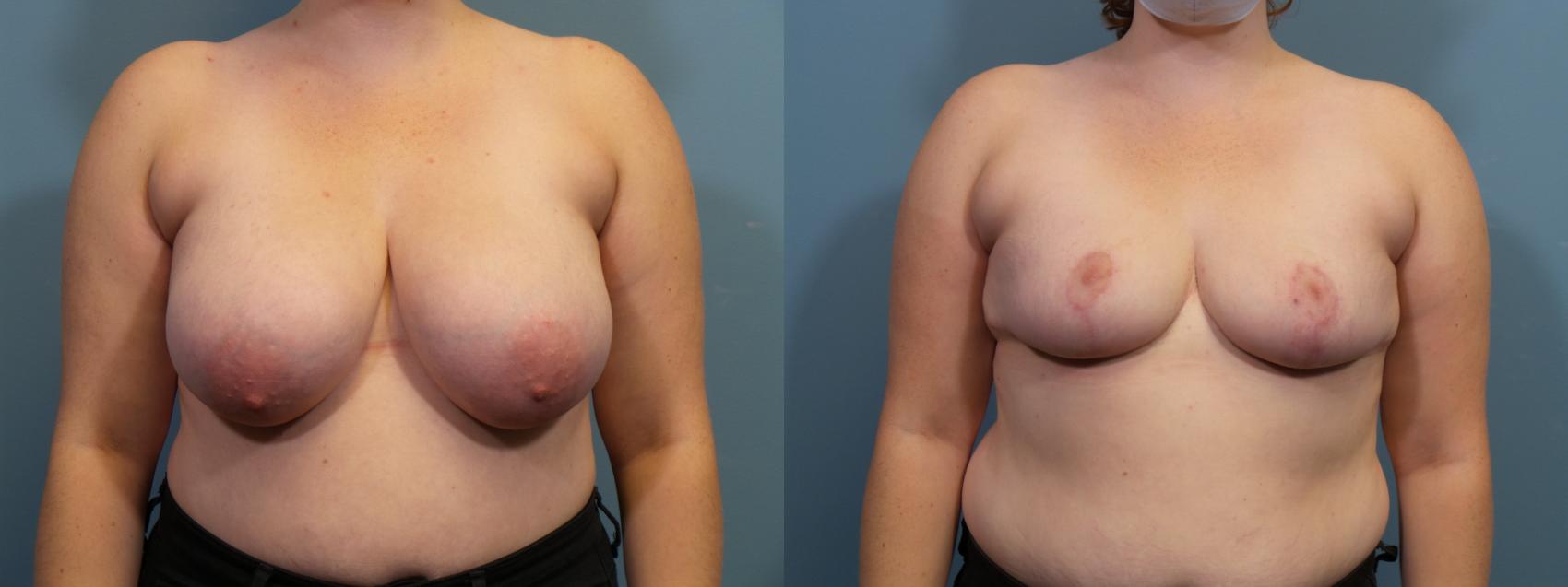 Before & After Breast Reduction Case 438 Front View in Portland, OR