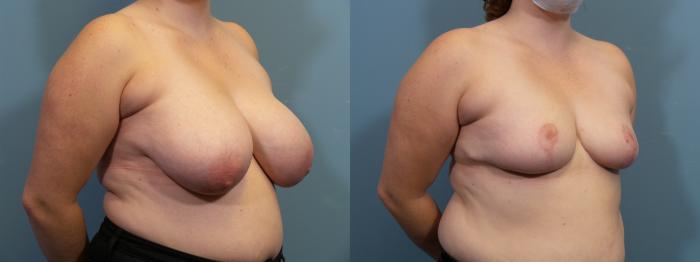 Before & After Breast Reduction Case 438 Right Oblique View in Portland, OR