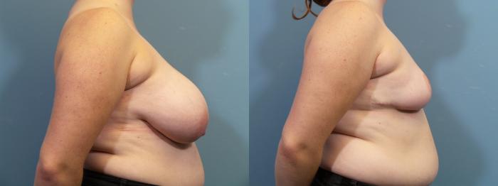 Before & After Breast Reduction Case 438 Right Side View in Portland, OR