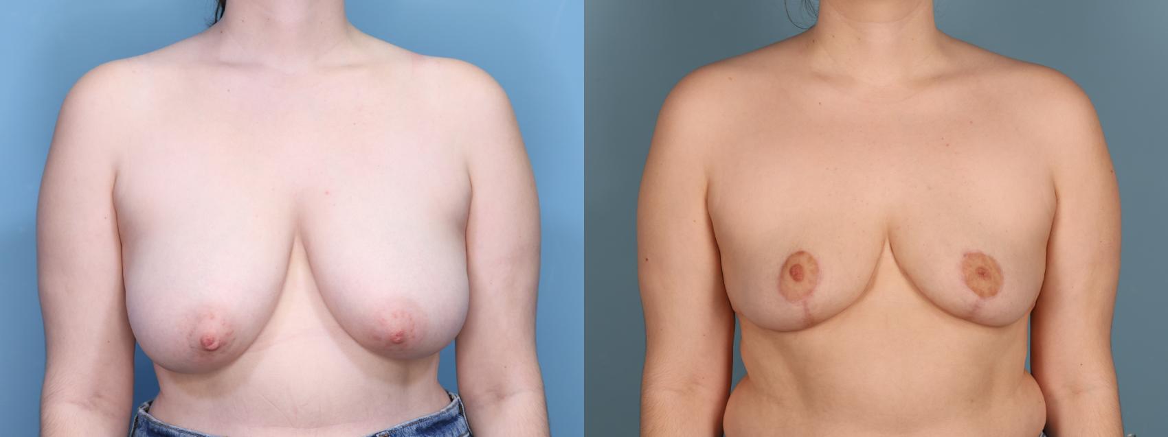 Before & After Breast Reduction Case 440 Front View in Portland, OR