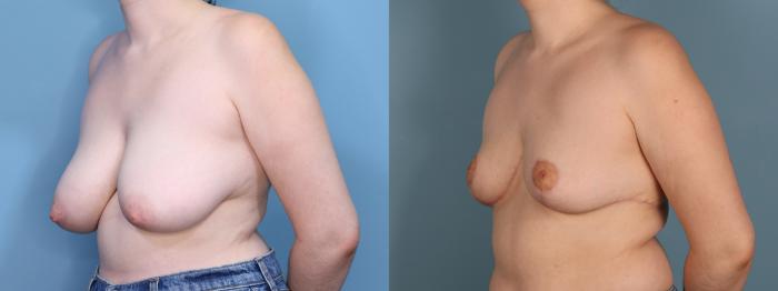 Before & After Breast Reduction Case 440 Right Oblique View in Portland, OR