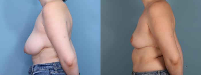 Before & After Breast Reduction Case 440 Right Side View in Portland, OR