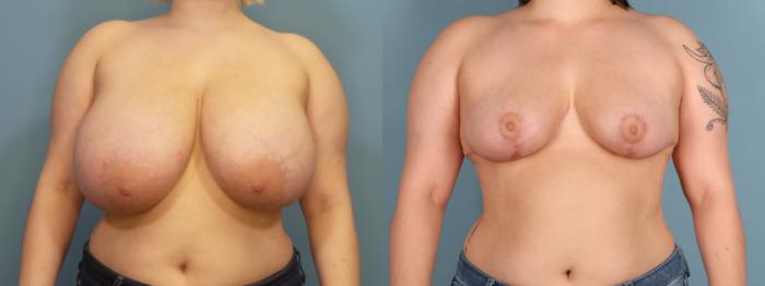 Before & After Breast Reduction Case 442 Front View in Portland, OR