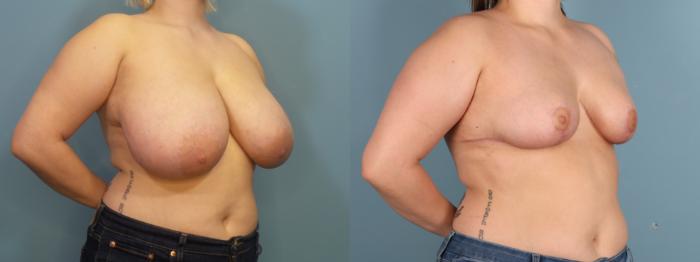 Before & After Breast Reduction Case 442 Left Oblique View in Portland, OR