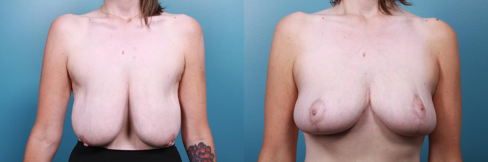 Before & After Breast Reduction Case 67 View #1 View in Portland, OR