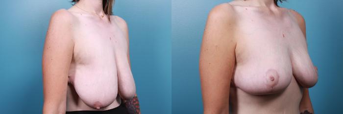 Before & After Breast Reduction Case 67 View #2 View in Portland, OR