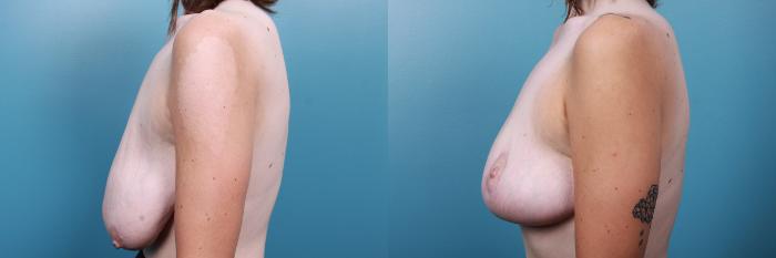 Before & After Breast Reduction Case 67 View #3 View in Portland, OR