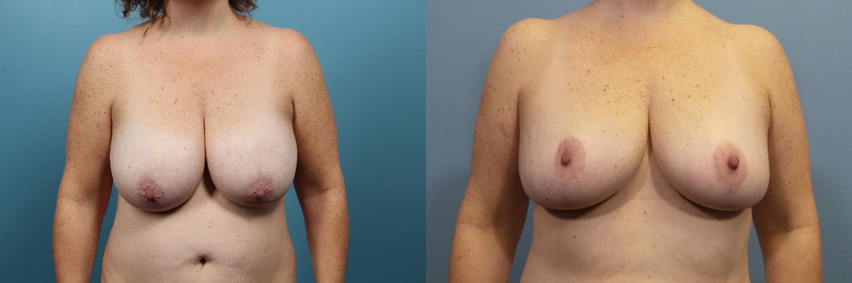 Before & After Breast Reduction Case 91 View #1 View in Portland, OR