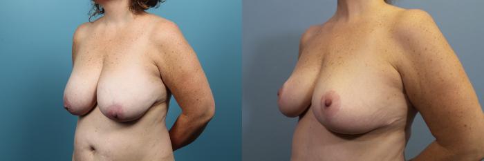 Before & After Breast Reduction Case 91 View #2 View in Portland, OR