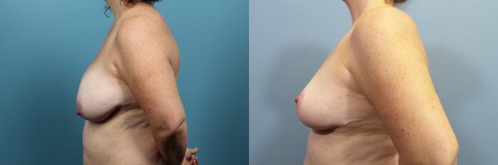 Before & After Breast Reduction Case 91 View #3 View in Portland, OR