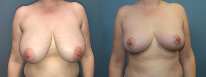 Before & After Breast Reduction Case 93 View #1 View in Portland, OR