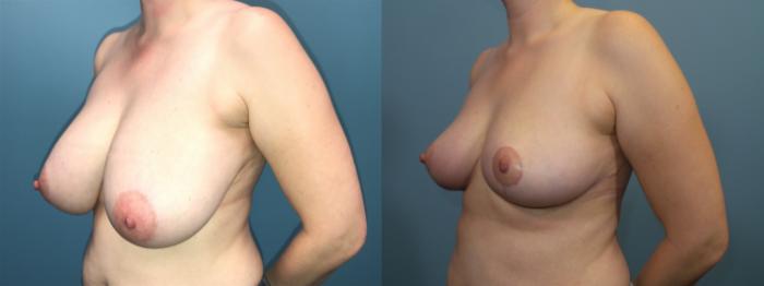 Before & After Breast Reduction Case 93 View #2 View in Portland, OR