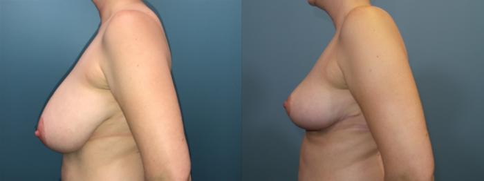 Before & After Breast Reduction Case 93 View #3 View in Portland, OR