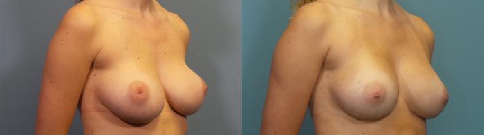 Before & After Breast Revision Case 344 Right Oblique View in Portland, OR