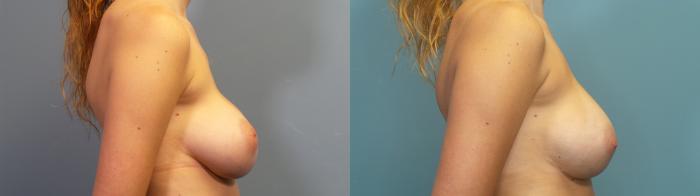 Before & After Breast Revision Case 344 Right Side View in Portland, OR