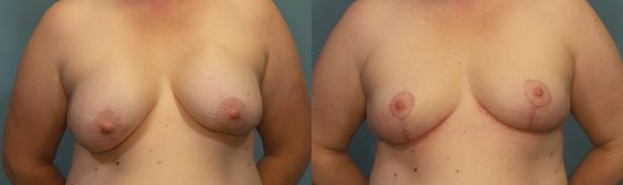 Before & After Breast Revision Case 345 Front View in Portland, OR
